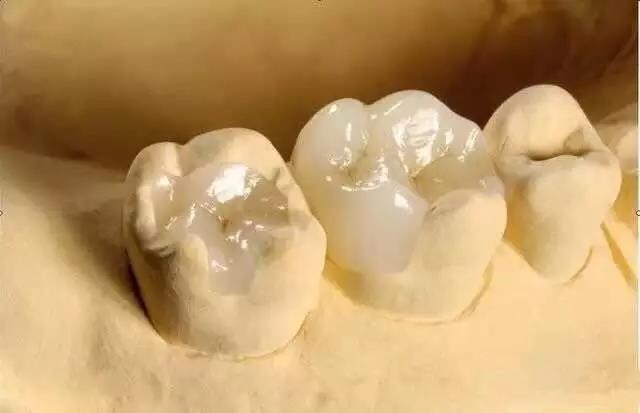 Zirconia Dental Inlay ສໍາລັບ Salvage ຄວາມບົກພ່ອງດ້ານຂະຫນາດນ້ອຍຂອງແຂ້ວທໍາມະຊາດ