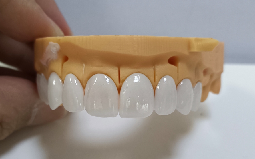 Veneers Emax Esthetic ສູງ