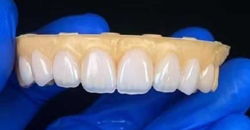 veneers ແຂ້ວເພື່ອສ້ອມແປງບັນຫາຂອງຊ່ອງຫວ່າງຂອງແຂ້ວເລ່ືອ