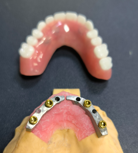 Locator ແລະ Titanium Dental Bar
