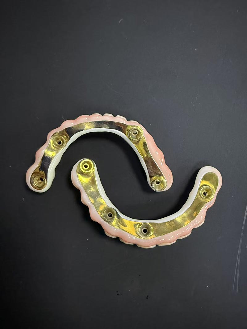 ຂໍ້ດີແລະຂໍ້ເສຍຂອງ Bar-Clip Implant-Supported Overdenture