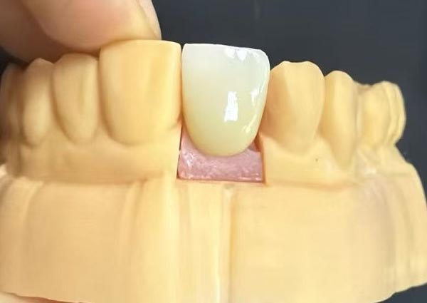 ຊ່ອງຫວ່າງລະຫວ່າງແຂ້ວສາມາດແກ້ໄຂໄດ້—ແຂ້ວຊື່ເປັນທີ່ດຶງດູດທີ່ສຸດ!