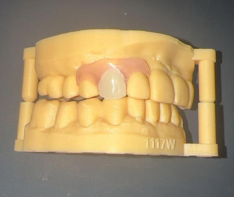 Flexible Partial Denture: The Aesthetic & Comfortable Restoration by Chinese Dental Lab & WM Dental Lab