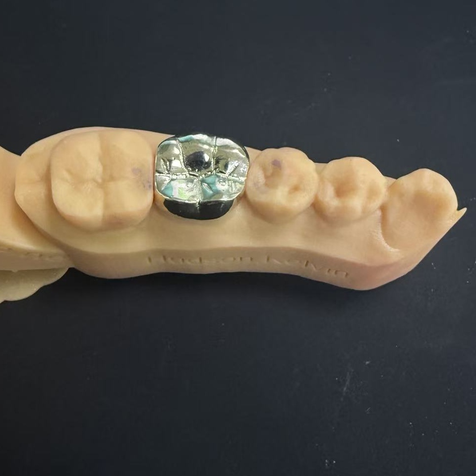 ເຮືອນຍອດທອງ: ທາງເລືອກໂລຫະທີ່ມີຄ່າສໍາລັບການຟື້ນຟູແຂ້ວຕະຫຼອດຊີວິດ