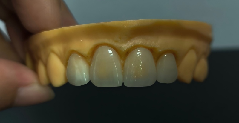 ຊີວິດຂອງ Porcelain Veneers ແມ່ນຫຍັງ?