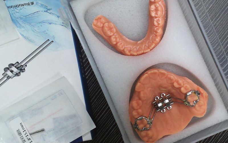 ເຂົ້າໃຈ MSE Skeletal Expansion ກັບ WM Dental Lab