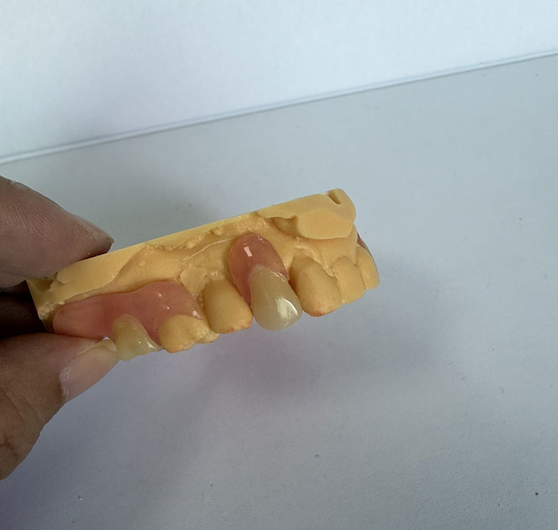 Valplast Partials ຢູ່ WM Dental Lab