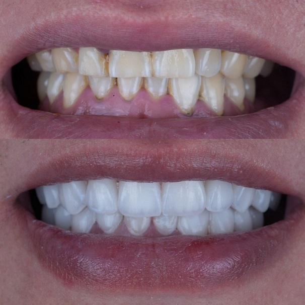 Emax Layered Veneers Esthetic China Dental Lab ເຮັດວຽກ