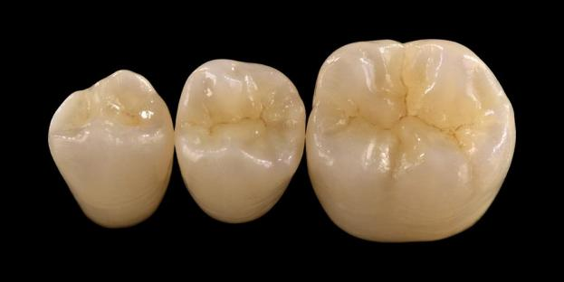 <h2>Zirconia ໃນທັນຕະກໍາ: ຕົວຊີ້ວັດ, ຂໍ້ໄດ້ປຽບ, ແລະການພິຈາລະນາທາງດ້ານການຊ່ວຍ</h2>
<p>Zirconia ໄດ້ຖືກຮັບຮູ້ຢ່າງກວ້າງຂວາງສໍາລັບຄວາມເຂັ້ມແຂງແລະຄວາມທົນທານຂອງມັນ. ວັດສະດຸ zirconia ລຸ້ນລ້າສຸດຍັງສະເຫນີຄຸນສົມບັດດ້ານຄວາມງາມທີ່ປັບປຸງຢ່າງຫຼວງຫຼາຍ. ສໍາລັບຄົນເຈັບທີ່ພິຈາລະນາການຟື້ນຟູເຊລາມິກທັງຫມົດ, ມັນເປັນສິ່ງຈໍາເປັນທີ່ຈະຕ້ອງປະເມີນຢ່າງລະມັດລະວັງທັງຕົວຊີ້ວັດແລະຂໍ້ຈໍາກັດຂອງລະບົບທີ່ອີງໃສ່ zirconia.</p>
<p>ຄົນເຈັບໃນມື້ນີ້ເພີ່ມຂຶ້ນຄາດຫວັງວ່າການຟື້ນຕົວທີ່ປະສົມປະສານຄວາມງາມທີ່ດີເລີດກັບການປະຕິບັດທີ່ເປັນປະໂຫຍດຢ່າງເຕັມທີ່. ລະບົບເຊລາມິກທີ່ທັນສະໄຫມສ່ວນໃຫຍ່ສາມາດຕອບສະຫນອງຄວາມຄາດຫວັງເຫຼົ່ານີ້, ແຕ່ຜົນສໍາເລັດທາງດ້ານຄລີນິກສ່ວນໃຫຍ່ແມ່ນຂຶ້ນກັບການເລືອກວັດສະດຸທີ່ເຫມາະສົມ, ການກະກຽມແຂ້ວ, ແລະພິທີການຊີມັງ. ທາງເລືອກຄວນໄດ້ຮັບການນໍາພາໂດຍຄຸນສົມບັດວັດສະດຸທີ່ສໍາຄັນເຊັ່ນ: ຄວາມຕ້ານທານກະດູກຫັກ, ຄວາມທົນທານຂອງ flexural, ຄວາມຕ້ານທານກັບພັຍ, ແລະຄວາມຫມັ້ນຄົງໃນໄລຍະຍາວ. ໃນບັນດາວັດສະດຸເຫຼົ່ານີ້, zirconia ໄດ້ກາຍເປັນຫນຶ່ງໃນທາງເລືອກທີ່ຖືກນໍາໃຊ້ຢ່າງກວ້າງຂວາງໃນ dentistry ການຟື້ນຟູທີ່ທັນສະໄຫມ.</p>
<h3>ເປັນຫຍັງຕ້ອງເລືອກ Zirconia?</h3>
<p>Zirconia ແມ່ນມີມູນຄ່າສໍາລັບຄວາມເຂັ້ມແຂງພິເສດແລະຄວາມທົນທານໃນໄລຍະຍາວ. zirconia ທີ່ທັນສະໄຫມແມ່ນແຕກຕ່າງກັນຢ່າງຫຼວງຫຼາຍຈາກລຸ້ນກ່ອນ, ເຊິ່ງມີຄວາມໂປ່ງໃສແລະຄວາມງາມຫນ້ອຍ. ໃນມື້ນີ້, ເຕັກໂນໂລຊີ CAD / CAM ຊ່ວຍໃຫ້ການຜະລິດທີ່ຊັດເຈນຂອງການຟື້ນຟູ zirconia ທີ່ມີຄຸນສົມບັດ optical ປັບປຸງ.</p>
<p>ການ​ຟື້ນ​ຟູ​ສາ​ມາດ​ໄດ້​ຮັບ​ການ​ອອກ​ແບບ​ເປັນ​:</p>
<ul>
<li><strong>Monolithic zirconia:</strong>ເຫມາະສໍາລັບເຮືອນຍອດຫລັງແລະຂົວ, ສະຫນອງຄວາມເຂັ້ມແຂງແລະຄວາມທົນທານສູງ.</li>
<li><strong>zirconia ຊັ້ນ:</strong>ເຫມາະສໍາລັບກໍລະນີທີ່ຕ້ອງການເສີມຄວາມງາມ, ລວມທັງການຟື້ນຟູໄລຍະຍາວໃນທົ່ວພື້ນທີ່ຕ່າງໆຂອງປາກ.</li>
</ul>
<p>ຄວາມເຂັ້ມແຂງ Flexural ແຕກຕ່າງກັນໄປຕາມປະເພດ, ຕັ້ງແຕ່ປະມານ 590 MPa ໃນ zirconia ທີ່ມີຄວາມໂປ່ງໃສສູງເຖິງ 1400 MPa ໃນຮູບແບບ monolithic. ການຟື້ນຟູ zirconia ສາມາດຖືກຊີມັງໂດຍໃຊ້ຊີມັງ resin ທີ່ມີກາວດ້ວຍຕົນເອງຫຼືຊີມັງ ionomer ແກ້ວທີ່ດັດແປງຢາງ.</p>
<h3>ປັດໃຈສໍາຄັນໃນການຄັດເລືອກວັດສະດຸ Zirconia</h3>
<p>ເມື່ອພິຈາລະນາ zirconia ສໍາລັບການຟື້ນຟູເຊລາມິກທັງຫມົດ, ແພດຄວນຈະປະເມີນປັດໃຈສໍາຄັນຫຼາຍ:</p>
<ul>
<li>ໂຄງສ້າງແຂ້ວທີ່ຍັງເຫຼືອ</li>
<li>ສະຖານທີ່ຢູ່ໃນຊ່ອງປາກ (ເຂດຄວາມງາມ vs ເຂດທີ່ເປັນປະໂຫຍດ)</li>
<li>ການປະກົດຕົວຂອງນິໄສ parafunctional ເຊັ່ນ bruxism</li>
<li>Translucency ຂອງແຂ້ວທໍາມະຊາດທີ່ຢູ່ຕິດກັນ</li>
<li>ສີແລະສະພາບຂອງໂຄງສ້າງແຂ້ວທີ່ຕິດພັນ</li>
</ul>
<p>ເຂດຄວາມງາມໂດຍທົ່ວໄປປະກອບມີແຂ້ວດ້ານຫນ້າ, ເຖິງແມ່ນວ່າໃນຄົນເຈັບບາງຄົນມັນອາດຈະຂະຫຍາຍໄປເຖິງ molar ທໍາອິດໂດຍອີງຕາມເສັ້ນຍິ້ມແລະການເຄື່ອນໄຫວຂອງໃບຫນ້າ. ເຂດທີ່ເປັນປະໂຫຍດໂດຍທົ່ວໄປປະກອບມີ premolars ແລະ molars, ບ່ອນທີ່ກໍາລັງ occlusal ແມ່ນສູງກວ່າຢ່າງຫຼວງຫຼາຍ.</p>
<h3>ແອັບພລິເຄຊັນເຂດຟັງຊັນ</h3>
<p>ໃນເຂດຫລັງ, ກໍາລັງ occlusal ຕ້ອງໄດ້ຮັບການພິຈາລະນາຢ່າງລະອຽດ. Zirconia ເປັນທາງເລືອກທີ່ດີເລີດສໍາລັບການຟື້ນຟູ PFM ແບບດັ້ງເດີມ, ໂດຍສະເພາະໃນກໍລະນີທີ່ມີພື້ນທີ່ຟື້ນຟູຈໍາກັດ. zirconia monolithic ທີ່ທັນສະໄຫມອະນຸຍາດໃຫ້ອອກແບບເຕັມຮູບແບບຂອງ occlusal anatomy, ລວມທັງ cusps ທີ່ເປັນປະໂຫຍດແລະຂອບຂອບ, ໃນຂະນະທີ່ຮັກສາຄວາມເຂັ້ມແຂງສູງ.</p>
<p>ຫຼັກຖານໃນປະຈຸບັນສະແດງໃຫ້ເຫັນວ່າ zirconia monolithic ແມ່ນເຫມາະສົມດີສໍາລັບເຮືອນຍອດຫລັງແລະຂົວຫຼາຍຫນ່ວຍເນື່ອງຈາກຄວາມຕ້ານທານທີ່ດີເລີດຕໍ່ການກະດູກຫັກແລະການສວມໃສ່. ຄວາມກ້າວຫນ້າຂອງເຕັກນິກການກາວແລະການອອກແບບການກະກຽມຍັງໄດ້ປັບປຸງຜົນໄດ້ຮັບທາງດ້ານການຊ່ວຍໃນໄລຍະຍາວ.</p>
<h3>ຄໍາຮ້ອງສະຫມັກເຂດຄວາມງາມ</h3>
<p>ຢູ່ໃນພາກພື້ນດ້ານຫນ້າ, ການຟື້ນຟູຕ້ອງ replicate ຢ່າງໃກ້ຊິດຂອງສີແຂ້ວທໍາມະຊາດ, translucency, ແລະພຶດຕິກໍາແສງສະຫວ່າງ. ໃນຂະນະທີ່ວັດສະດຸເຊັ່ນ: lithium disilicate ສະຫນອງຄວາມງາມທີ່ດີເລີດ, ພວກມັນມີຄວາມເຂັ້ມແຂງຫນ້ອຍແລະປົກກະຕິຕ້ອງການການຍຶດຕິດ.</p>
<p>A ປະໂຫຍດທີ່ສໍາຄັນຂອງ zirconia ແມ່ນຄວາມສາມາດຂອງຕົນທີ່ຈະໄດ້ຮັບການ cemented ຕາມທໍາມະດາໃນຂະນະທີ່ຍັງບັນລຸປະສິດທິພາບດ້ານຄວາມງາມສູງ. ດ້ວຍການພັດທະນາລະບົບ zirconia ທີ່ມີຄວາມໂປ່ງໃສສູງແລະຫຼາຍຊັ້ນ, ປະຈຸບັນສາມາດຜະລິດການຟື້ນຟູທີ່ຄ້າຍຄືກັບແຂ້ວທໍາມະຊາດຢ່າງໃກ້ຊິດ.</p>
<p>ເຕັກນິກການປຸງແຕ່ງແບບພິເສດເພີ່ມຄຸນສົມບັດ optical ແລະຫຼຸດຜ່ອນຄວາມບໍ່ສົມບູນທີ່ອາດຈະສົ່ງຜົນກະທົບຕໍ່ການຖ່າຍທອດແສງສະຫວ່າງແລະຮູບລັກສະນະ.</p>
<h3>ຄວາມເຂັ້ມແຂງແລະຄວາມງາມປະສົມປະສານ</h3>
<p>ລະບົບ zirconia ເບື້ອງຕົ້ນໄດ້ບູລິມະສິດຄວາມເຂັ້ມແຂງແຕ່ຂາດຄຸນນະພາບກ່ຽວກັບຄວາມງາມ. zirconia monolithic ທີ່ທັນສະໄຫມປະສົມປະສານຢ່າງສໍາເລັດຜົນທັງຄວາມເຂັ້ມແຂງແລະການປັບປຸງຮູບລັກສະນະ, ເຮັດໃຫ້ມັນເຫມາະສົມສໍາລັບກໍລະນີທາງດ້ານຄລີນິກທີ່ກວ້າງຂວາງ.</p>
<p>ມັນເປັນປະໂຫຍດໂດຍສະເພາະສໍາລັບຄົນເຈັບທີ່ມີນິໄສ parafunctional ຫຼືຄວາມລົ້ມເຫຼວຂອງການຟື້ນຟູທີ່ຜ່ານມາ. ການສຶກສາທາງດ້ານຄລີນິກຊີ້ໃຫ້ເຫັນເຖິງການຍອມຮັບຂອງຄົນເຈັບສູງແລະອັດຕາອາການແຊກຊ້ອນຕ່ໍາ.</p>
<p>ຄວາມກັງວົນກ່ຽວກັບການສວມໃສ່ກັບແຂ້ວປອມໄດ້ຖືກຫຼຸດລົງດ້ວຍຮູບແບບໃຫມ່ກວ່າ. ພື້ນຜິວ zirconia ຂັດສູງສະແດງໃຫ້ເຫັນເຖິງທ່າແຮງການຂັດຕ່ໍາ, ແລະໃນບາງກໍລະນີອາດຈະອ່ອນກວ່າການປະຕິສັງຂອນ porcelain-fused-metal.</p>
<h3>ການປູກຝັງ Zirconia: ທາງເລືອກທີ່ເກີດຂື້ນ</h3>
<p>ໃນຂະນະທີ່ການປູກຝັງ titanium ຍັງຄົງເປັນມາດຕະຖານທາງດ້ານຄລີນິກ, ການປູກຝັງ zirconia ກໍາລັງໄດ້ຮັບຄວາມສົນໃຈເປັນທາງເລືອກທີ່ບໍ່ມີໂລຫະ. ການອອກແບບໃນຕົ້ນໆແມ່ນຕົ້ນຕໍເປັນລະບົບຫນຶ່ງຊິ້ນ, ແຕ່ການປູກຝັງ zirconia ສອງຊິ້ນໃນປັດຈຸບັນອະນຸຍາດໃຫ້ປັບປຸງຄວາມຍືດຫຍຸ່ນຂອງຂາທຽມ.</p>
<p>ການປູກຝັງ Zirconia ແມ່ນເປັນປະໂຫຍດໂດຍສະເພາະໃນກໍລະນີທີ່ມີຄວາມກັງວົນກ່ຽວກັບຄວາມງາມ, ເຊັ່ນ: ການປ່ຽນສີສີຂີ້ເຖົ່າທີ່ເປັນໄປໄດ້ຂອງເນື້ອເຍື່ອ peri-implant ຫຼື biotype gingival ບາງໆ. ພວກເຂົາຍັງອາດຈະຖືກພິຈາລະນາສໍາລັບຄົນເຈັບທີ່ມີຄວາມອ່ອນໄຫວ titanium ທີ່ຫາຍາກ.</p>
<p>ຢ່າງໃດກໍຕາມ, ການປູກຝັງ zirconia ແມ່ນຂ້ອນຂ້າງໃຫມ່, ແລະຂໍ້ມູນທາງດ້ານການຊ່ວຍໃນໄລຍະຍາວຍັງຈໍາກັດເມື່ອທຽບກັບລະບົບ titanium.</p>
<h3>ສະຫຼຸບ</h3>
<p>Zirconia ໄດ້ພັດທະນາໄປສູ່ວັດສະດຸທີ່ມີຄວາມຍືດຫຍຸ່ນສູງໃນການຟື້ນຟູແຂ້ວ, ສະເຫນີຄວາມສົມດຸນທີ່ເຂັ້ມແຂງລະຫວ່າງການປະຕິບັດກົນຈັກແລະຄວາມງາມ. ການເລືອກກໍລະນີທີ່ເຫມາະສົມແລະການຍຶດຫມັ້ນກັບໂປໂຕຄອນທາງດ້ານຄລີນິກແມ່ນມີຄວາມຈໍາເປັນສໍາລັບການບັນລຸຜົນໄດ້ຮັບທີ່ດີທີ່ສຸດໃນການນໍາໃຊ້ທາງຫນ້າແລະຫລັງ.</p>
